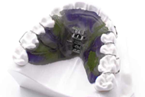 Braces removable appliance hawthorn