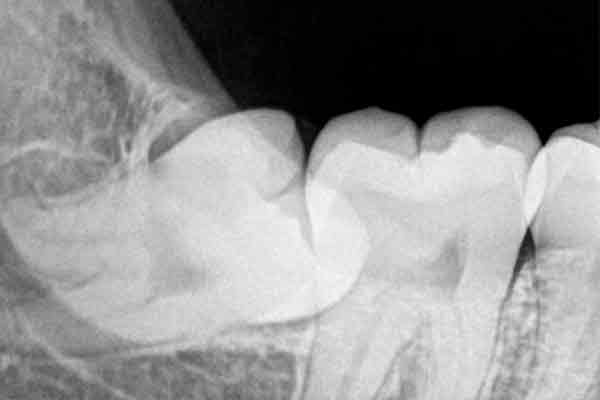 wisdom teeth removal hawthorn