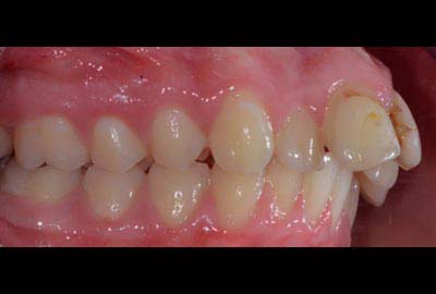 overjet treatment melbourne hawthorn