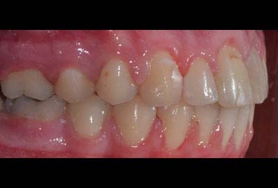 overjet treatment melbourne hawthorn