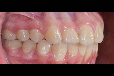 overjet treatment melbourne hawthorn